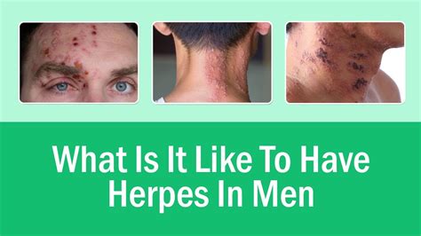 dating a man who has herpes